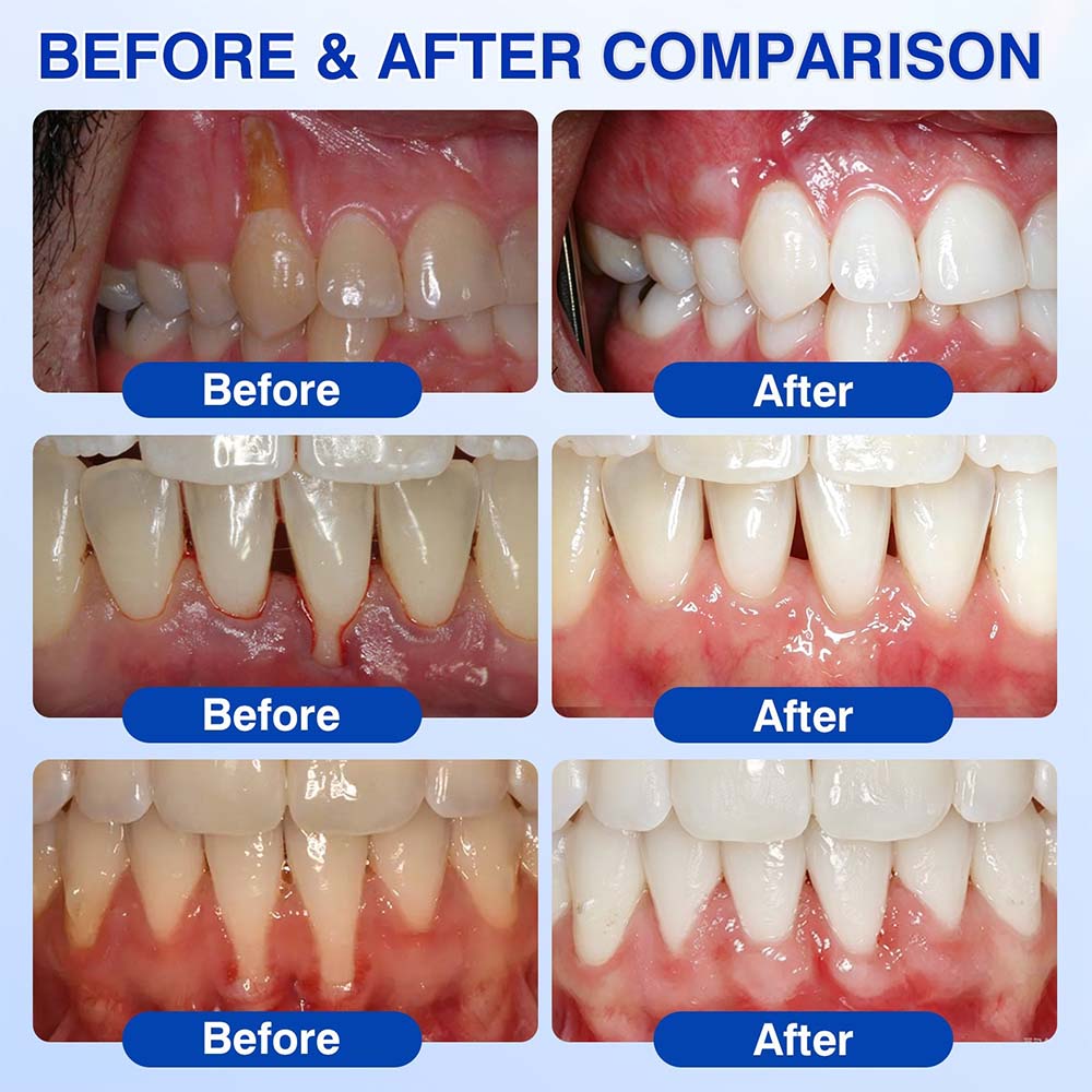 🦷UNITEM® GumRevive Periodontal Repair Gel (for bleeding gums, receding gums, and loose teeth) ✨ 🪐